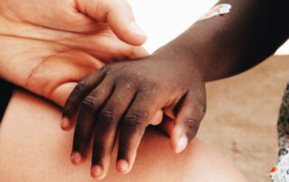 A woman gently holding a child's scarred and wounded hand.